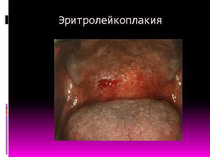 Эритролейкоплакия 