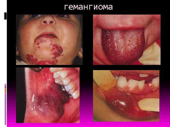 гемангиома 