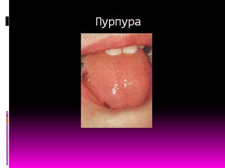 Пурпура 