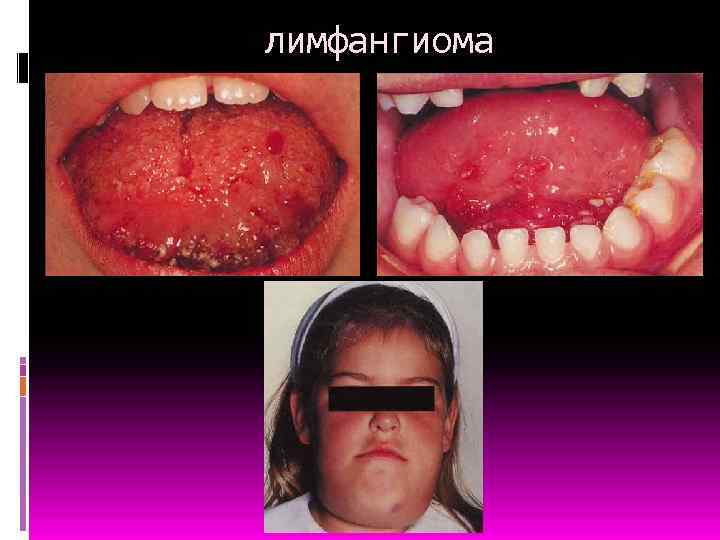 лимфангиома 