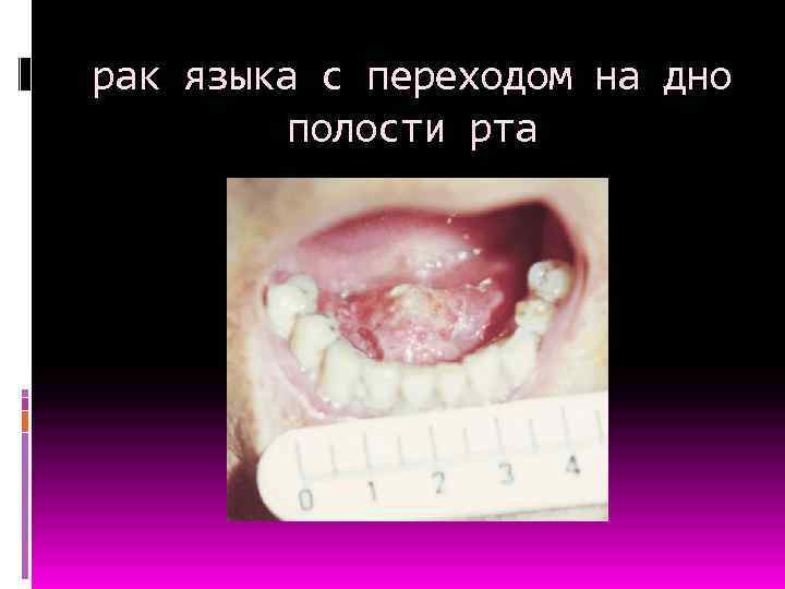 рак языка с переходом на дно полости рта 
