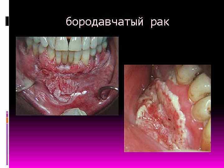 бородавчатый рак 