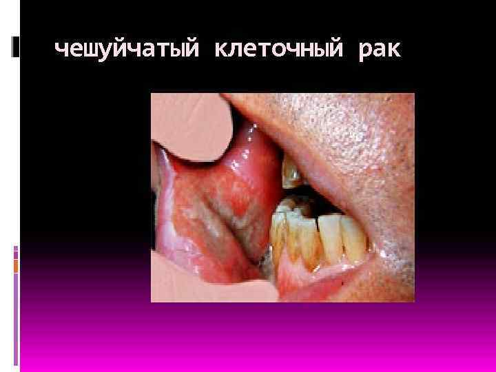 чешуйчатый клеточный рак 