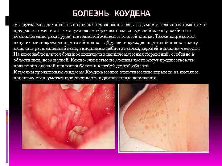 БОЛЕЗНЬ КОУДЕНА Это аутосомно-доминантный признак, проявляющийся в виде многочисленных гамартом и предрасположенностью к опухолевым