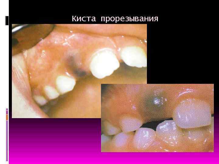Киста прорезывания 