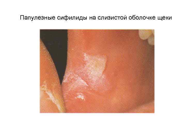 Папулезные сифилиды на слизистой оболочке щеки 