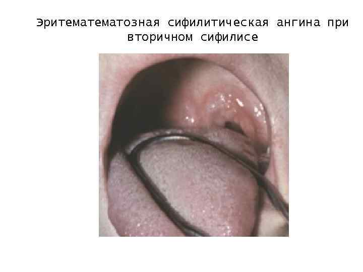 Эритематозная сифилитическая ангина при вторичном сифилисе 
