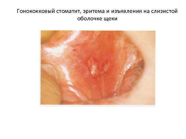 Гонококковый стоматит, эритема и изъявления на слизистой оболочке щеки 