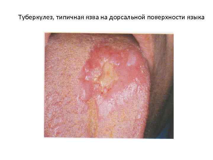 Туберкулез, типичная язва на дорсальной поверхности языка 