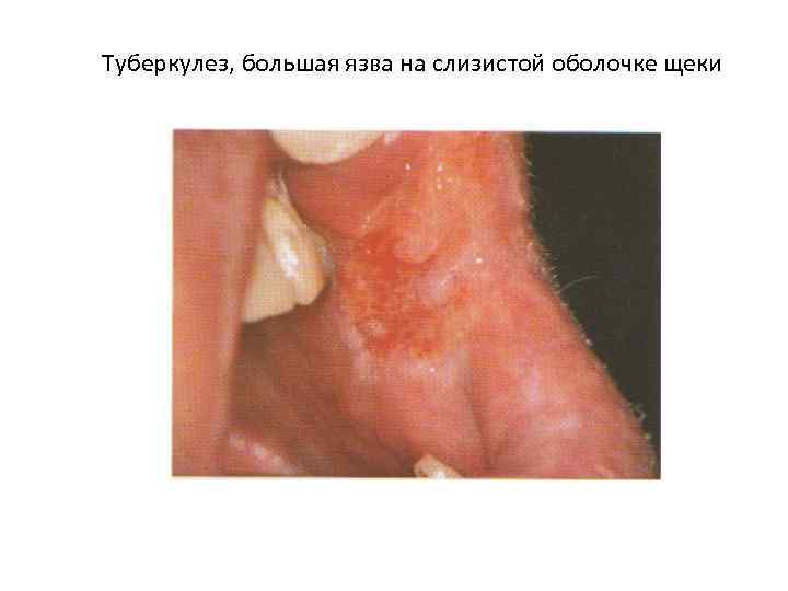 Туберкулез, большая язва на слизистой оболочке щеки 
