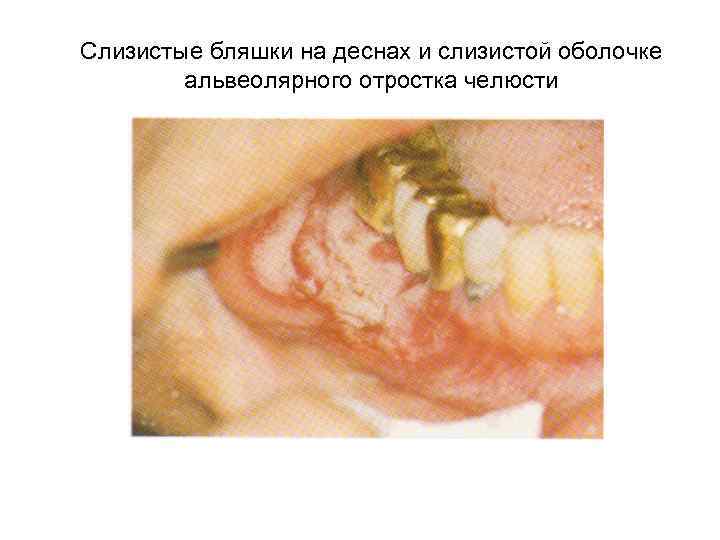 Слизистые бляшки на деснах и слизистой оболочке альвеолярного отростка челюсти 