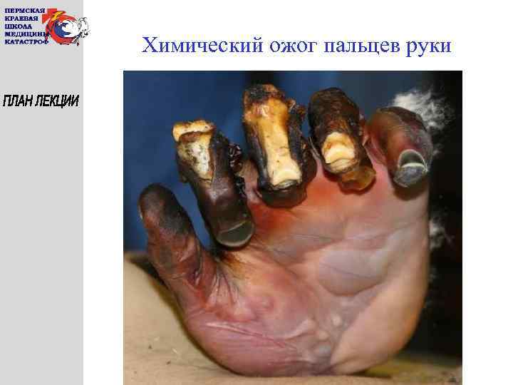 Химический ожог пальцев руки 