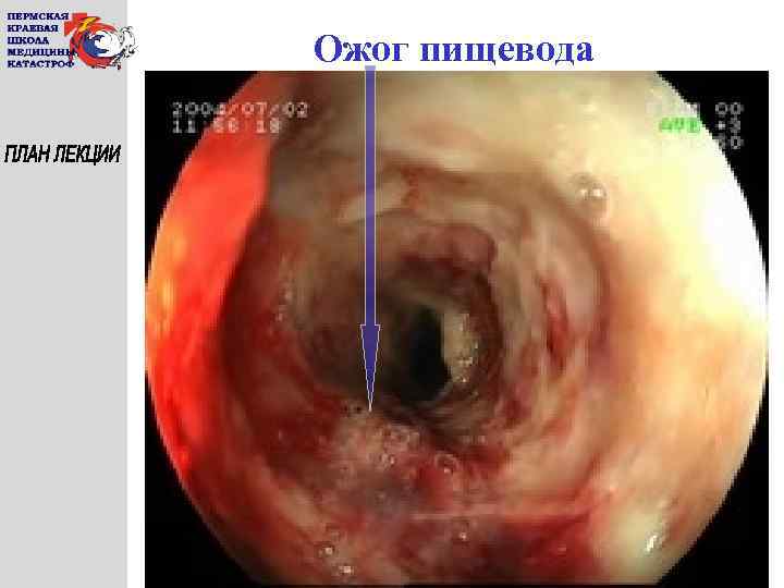 Ожог пищевода 