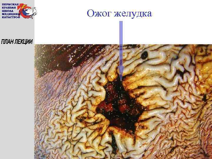 Ожог желудка 