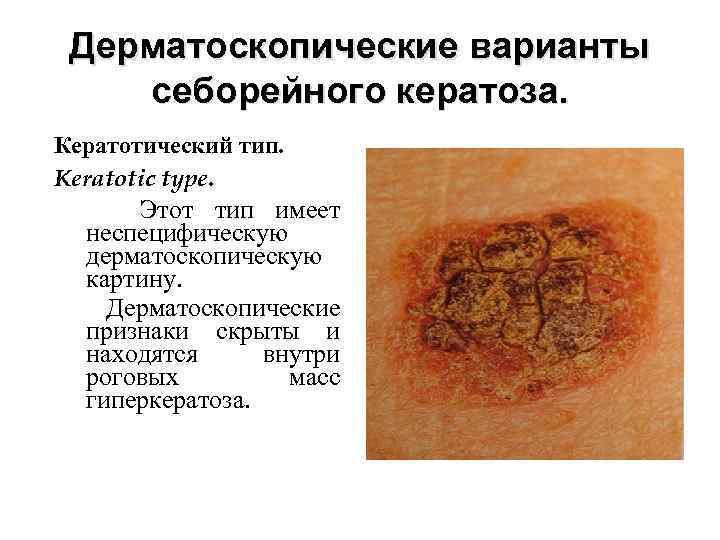 Дерматоскопические варианты себорейного кератоза. Кератотический тип. Keratotic type. Этот тип имеет неспецифическую дерматоскопическую картину.