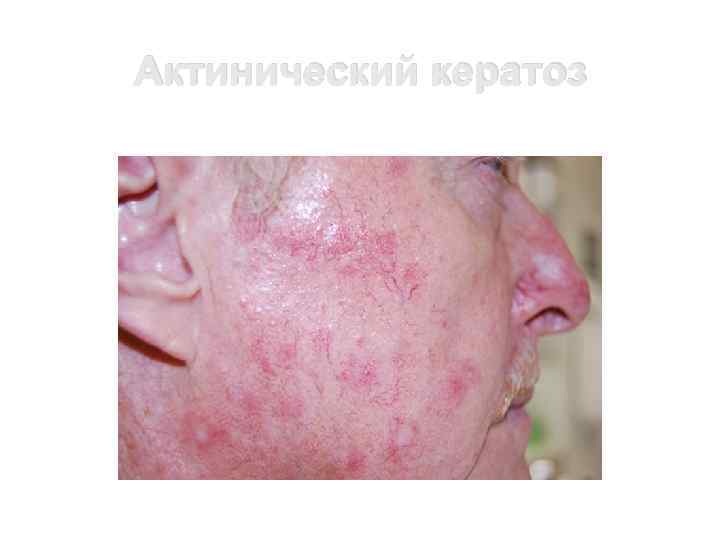 Актинический кератоз 