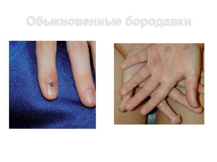 Обыкновенные бородавки 