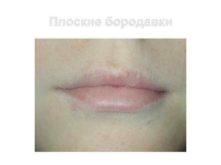 Плоские бородавки 