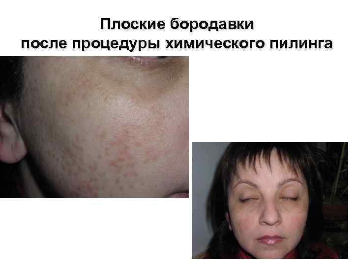 Плоские бородавки после процедуры химического пилинга 
