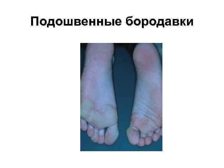Подошвенные бородавки 