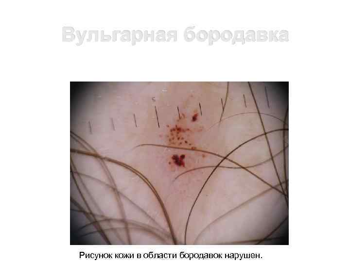 Вульгарная бородавка Рисунок кожи в области бородавок нарушен. 
