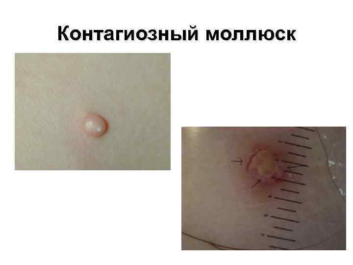Контагиозный моллюск 