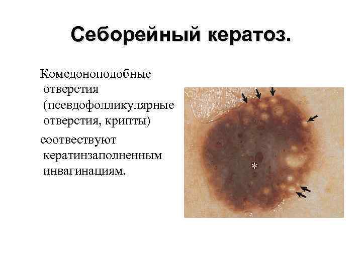 Себорейный кератоз. Комедоноподобные отверстия (псевдофолликулярные отверстия, крипты) соотвествуют кератинзаполненным инвагинациям. 