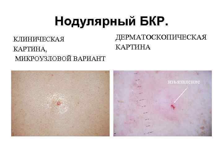 Нодулярный БКР. КЛИНИЧЕСКАЯ КАРТИНА, МИКРОУЗЛОВОЙ ВАРИАНТ ДЕРМАТОСКОПИЧЕСКАЯ КАРТИНА изъязвление 