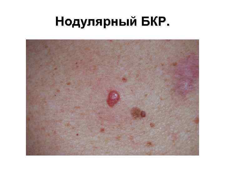 Нодулярный БКР. 