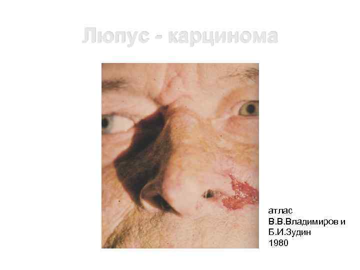 Люпус - карцинома атлас В. В. Владимиров и Б. И. Зудин 1980 
