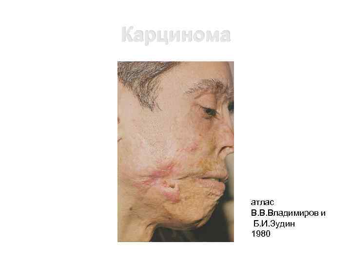 Карцинома атлас В. В. Владимиров и Б. И. Зудин 1980 