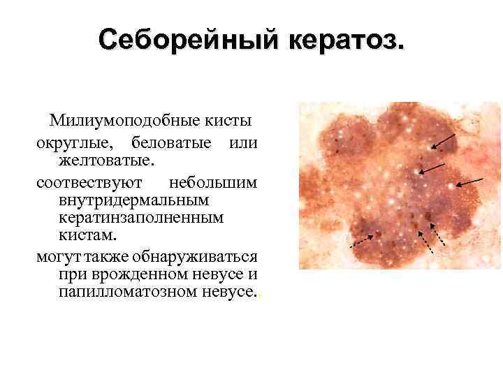 Себорейный кератоз. Милиумоподобные кисты округлые, беловатые или желтоватые. соотвествуют небольшим внутридермальным кератинзаполненным кистам. могут