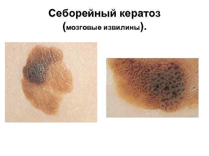 Себорейный кератоз (мозговые извилины). 