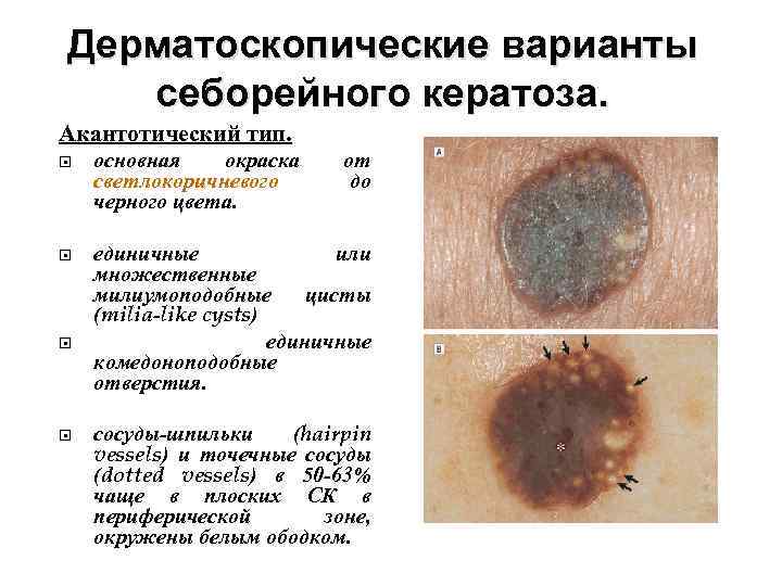 Дерматоскопические варианты себорейного кератоза. Акантотический тип. основная окраска светлокоричневого черного цвета. единичные или множественные
