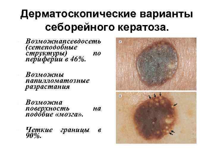 Дерматоскопические варианты себорейного кератоза. Возможнапсевдосеть (сетеподобные структуры) по периферии в 46%. Возможны папилломатозные разрастания