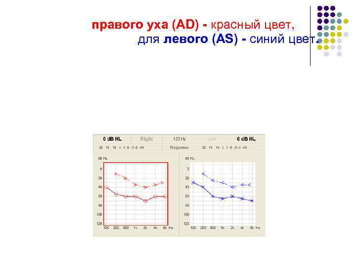 Аудиограмма строится отдельно для правого уха (AD) - красный цвет, для левого (AS) -