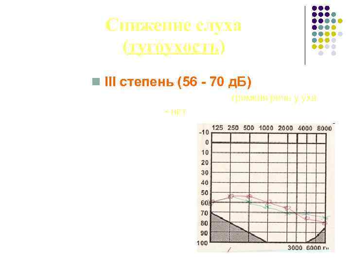 Снижение слуха (тугоухость) n III степень (56 - 70 д. Б) Восприятие разговорной и