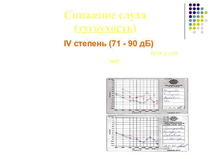 Снижение слуха (тугоухость) IV степень (71 - 90 д. Б) Восприятие разговорной и громкой