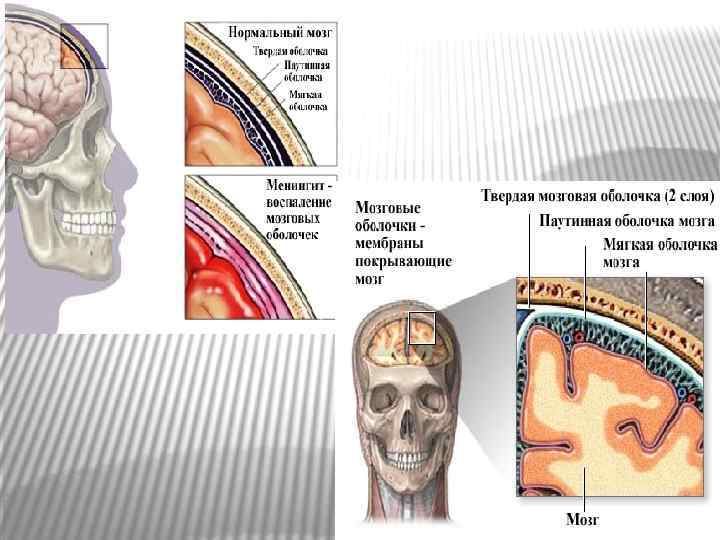 Туберкулезный менингит неврология презентация