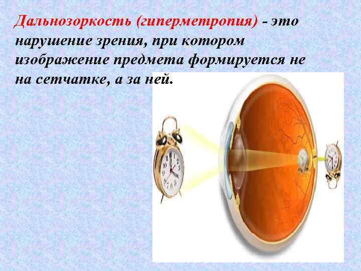 Дальнозоркость (гиперметропия) - это нарушение зрения, при котором изображение предмета формируется не на сетчатке,