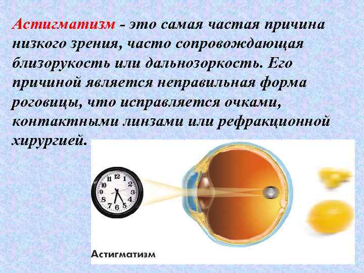 Астигматизм - это самая частая причина низкого зрения, часто сопровождающая близорукость или дальнозоркость. Его