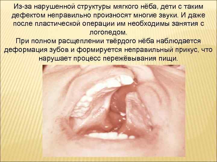 Из-за нарушенной структуры мягкого нёба, дети с таким дефектом неправильно произносят многие звуки. И