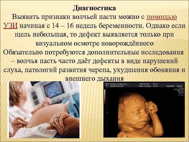 Диагностика Выявить признаки волчьей пасти можно с помощью УЗИ начиная с 14 – 16