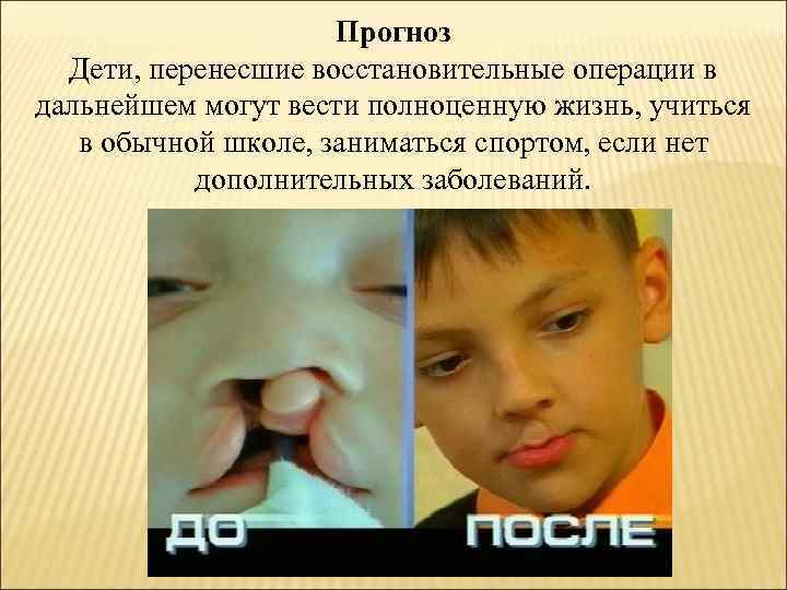 Прогноз Дети, перенесшие восстановительные операции в дальнейшем могут вести полноценную жизнь, учиться в обычной
