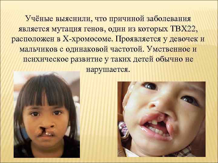 Учёные выяснили, что причиной заболевания является мутация генов, один из которых TBX 22, расположен