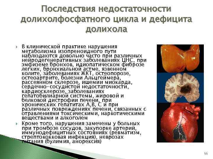 Последствия недостаточности долихолфосфатного цикла и дефицита долихола В клинической практике нарушения метаболизма изопреноидного пути