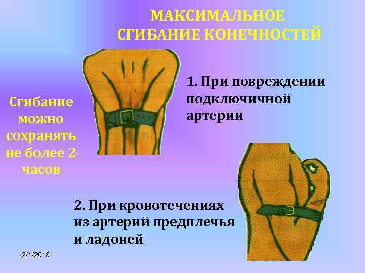 МАКСИМАЛЬНОЕ СГИБАНИЕ КОНЕЧНОСТЕЙ Сгибание можно сохранять не более 2 часов 1. При повреждении подключичной