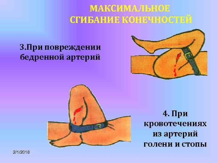 МАКСИМАЛЬНОЕ СГИБАНИЕ КОНЕЧНОСТЕЙ 3. При повреждении бедренной артерий 4. При кровотечениях из артерий голени