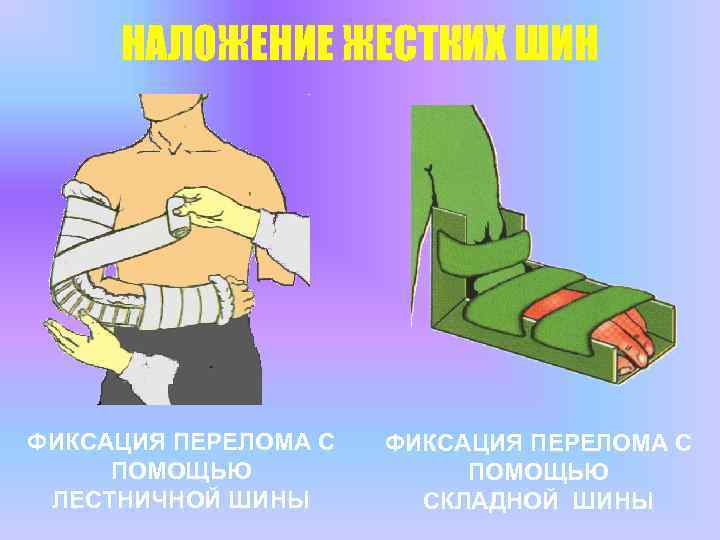 НАЛОЖЕНИЕ ЖЕСТКИХ ШИН ФИКСАЦИЯ ПЕРЕЛОМА С ПОМОЩЬЮ ЛЕСТНИЧНОЙ ШИНЫ ФИКСАЦИЯ ПЕРЕЛОМА С ПОМОЩЬЮ СКЛАДНОЙ