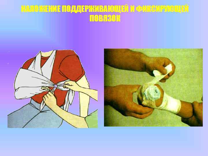 НАЛОЖЕНИЕ ПОДДЕРЖИВАЮЩЕЙ И ФИКСИРУЮЩЕЙ ПОВЯЗОК 